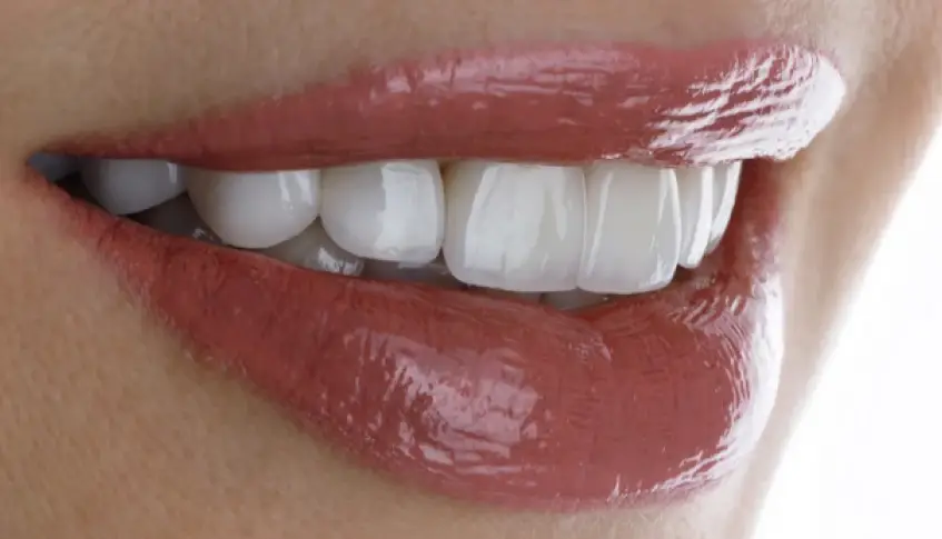 Diseño de sonrisa